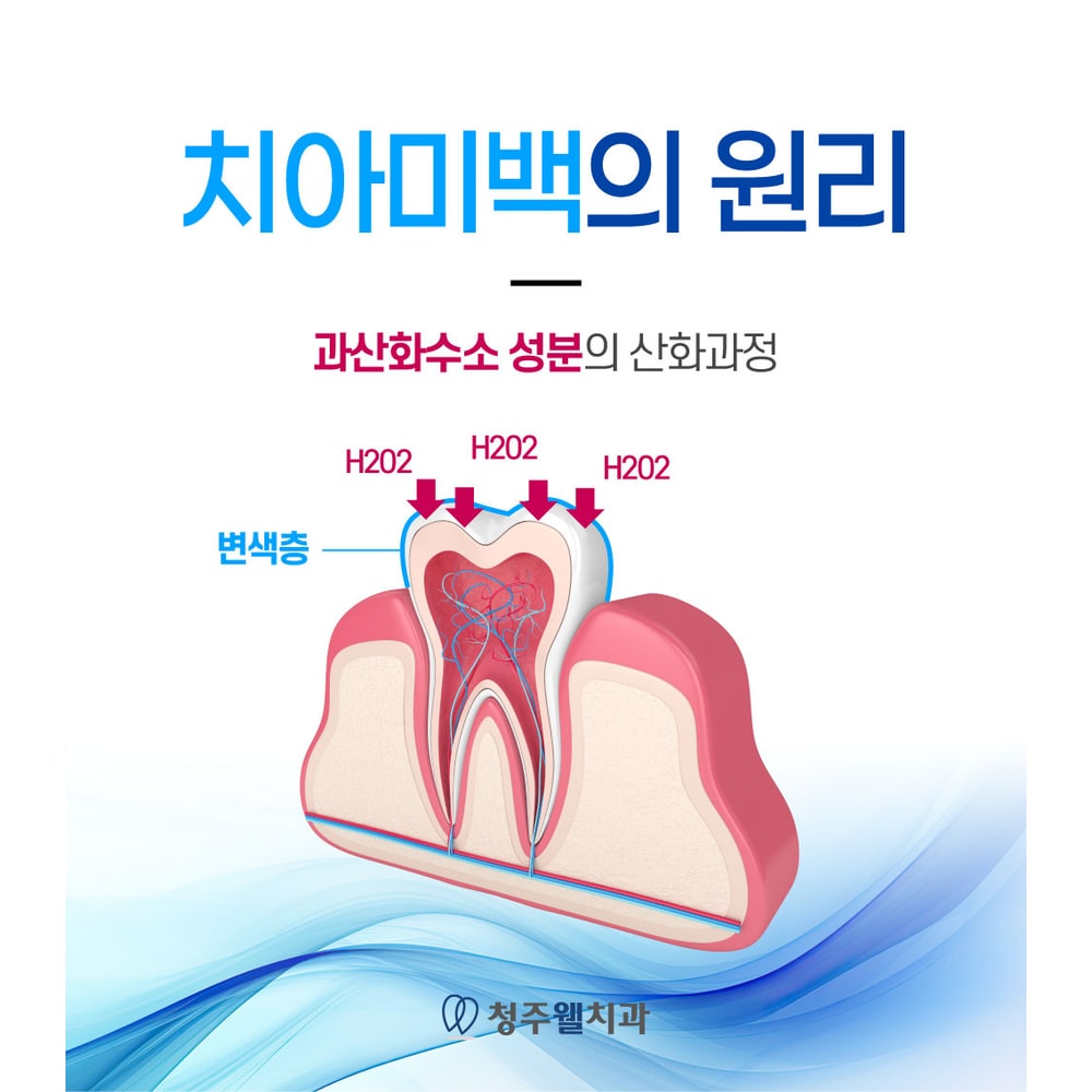 치아미백 원리 안내