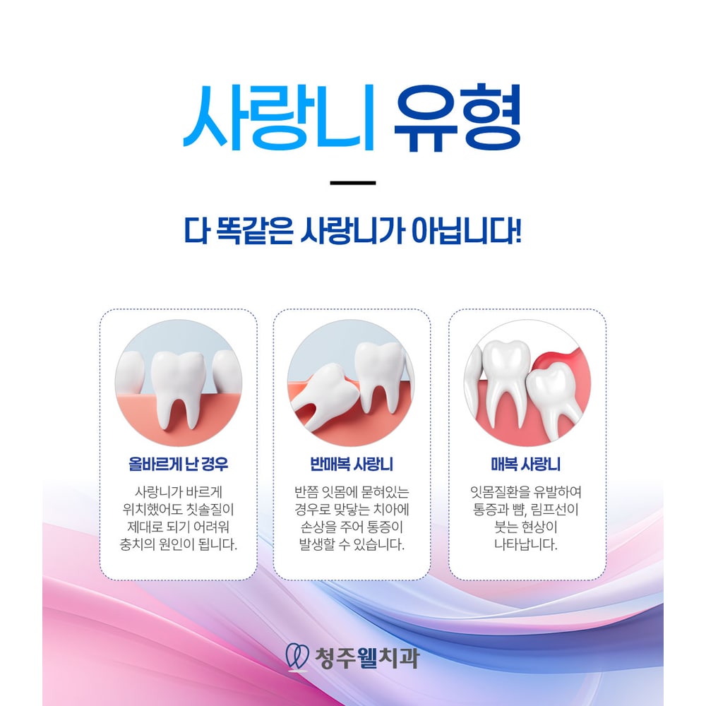 사랑니의 맹출 및 매복 유형 안내
